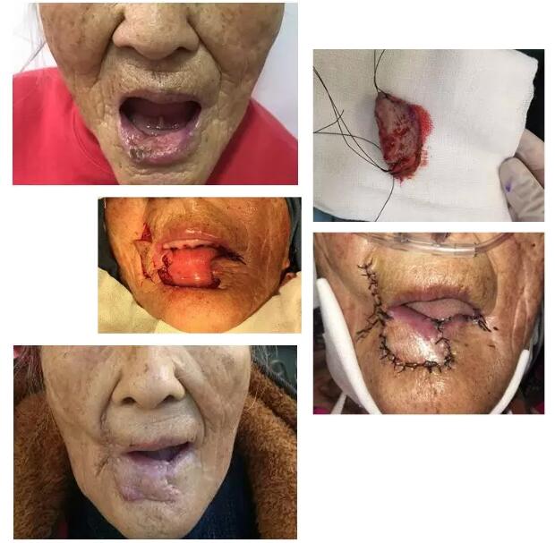 我院多学科诊疗为90多岁高龄下唇癌患者成功手术