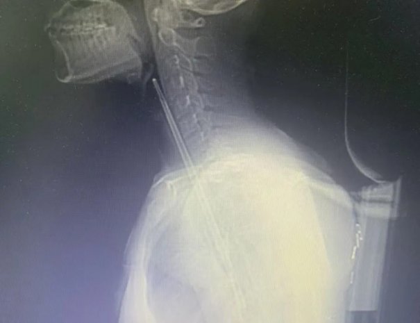 医疗资讯丨危险！20岁女子鱼刺卡喉急于求“筷”误吞食管 徐州一院耳鼻咽喉科专家团队食管镜下施救化险为夷