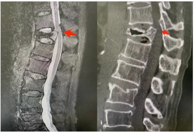 医路领先｜背痛难忍，走路无力？一次手术让他重新轻松行走 ——徐州一院成功开展椎体内cage支撑重建手术